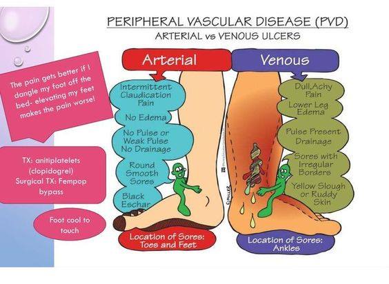 Serie Infografías: Úlceras Venosas vs  Arteriales