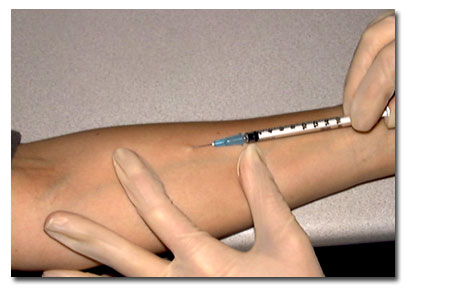 Test de Mantoux o Tuberculina