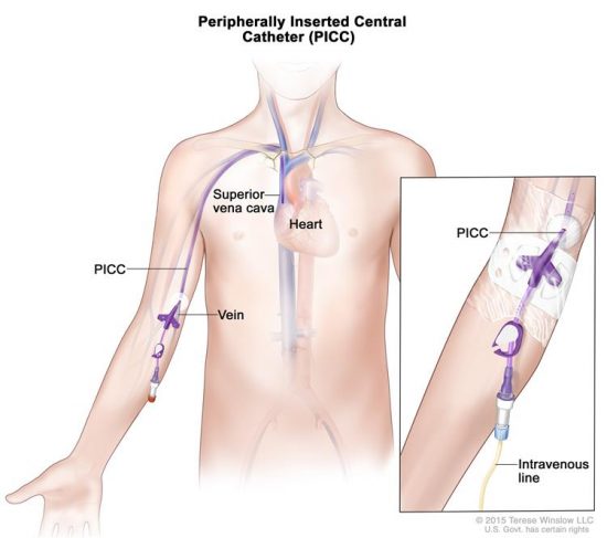 Mantenimiento de accesos venosos (lll): PICC