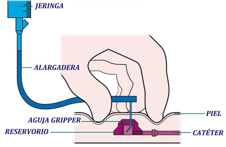 Mantenimiento de accesos venosos (l): Reservorio subcutáneo