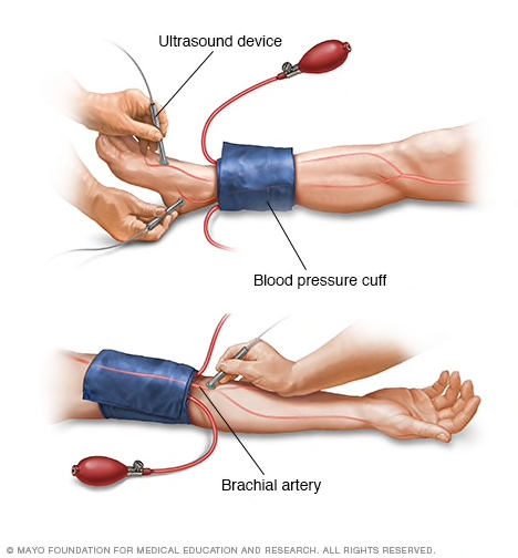 Cómo realizar la medición Índice Tobillo Brazo