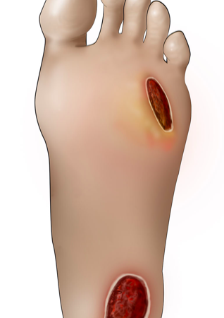 Pie diabético. Clasificación Wagner