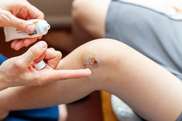 Uso de tratamiento antibiótico por vía tópica en heridas