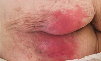 Lesiones cutáneas asociadas a la humedad